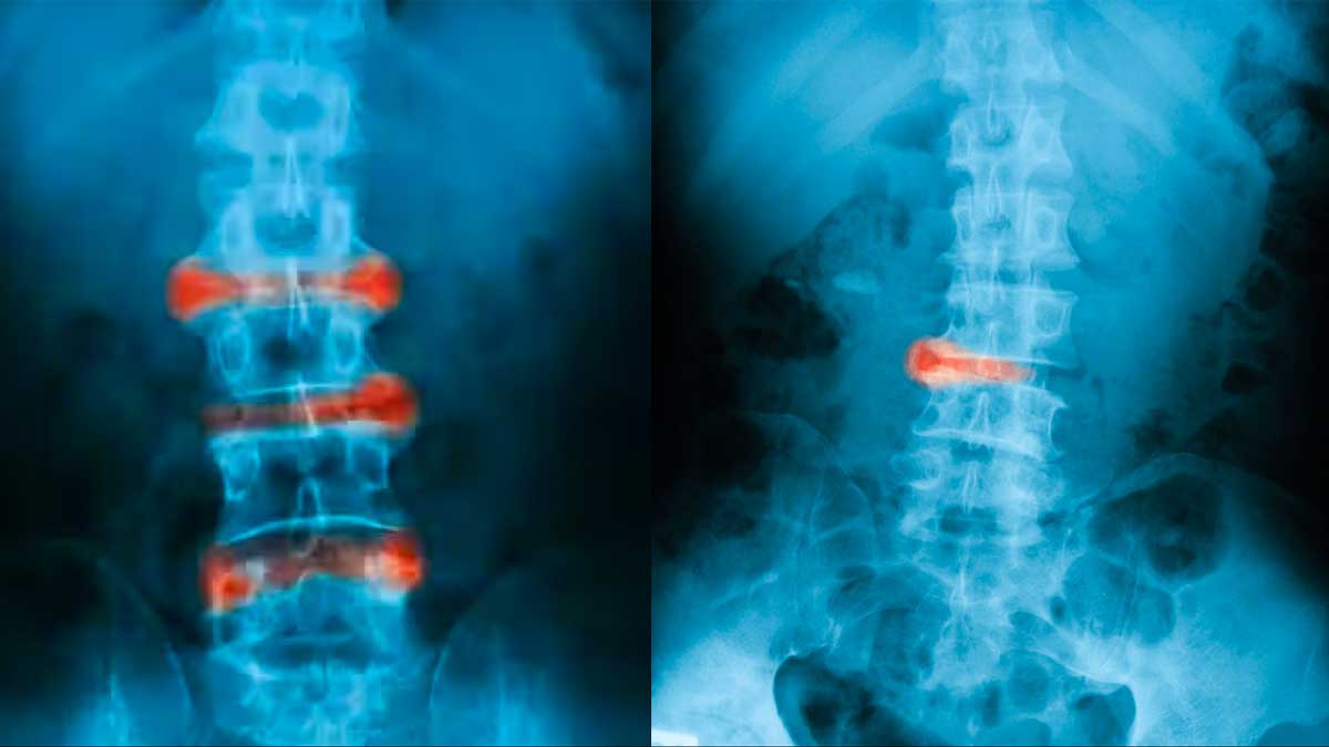 Ankylosing Spondylosis Bigg Boss 17 Khanzaadi