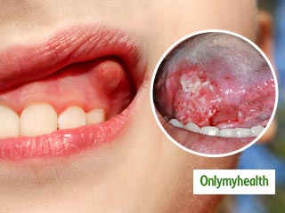 खराब दांतों के कारण भी हो सकता है जीभ का कैंसर, जानें इसके मुख्य लक्षण