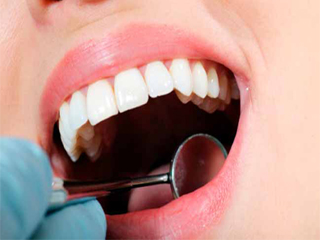 सौंदर्य को चार चांद लगाते हैं दांत 