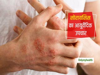 Skin Diseases: 6 प्रकार की होती है सोरायसिस की बीमारी, आयुर्वेदिक एक्&zwj;सपर्ट से जानिए Psoriasis का पूरा इलाज
