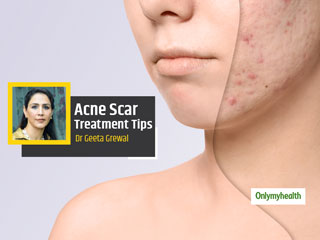 Acne Scars: Hiding Your Face Due To Acne Scars? Here&rsquo;s How To Get Rid Of Them