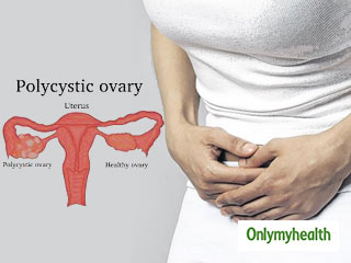 Expert Speaks: Top 10 questions about PCOD which you always wanted to ask your doctor