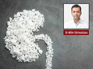 Warning Signs and Symptoms of Kidney Stones Revealed By Urologist