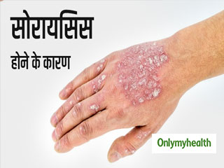 मौसम बदलने के साथ रहता है सोरायसिस का खतरा, जानें क्&zwj;या हैं इसके कारण 