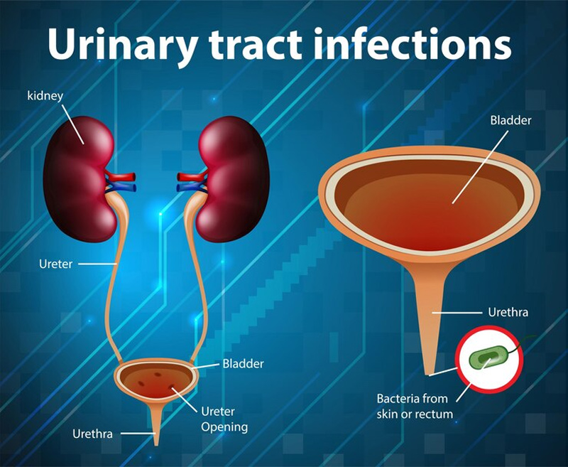 Urinary-tract-infection